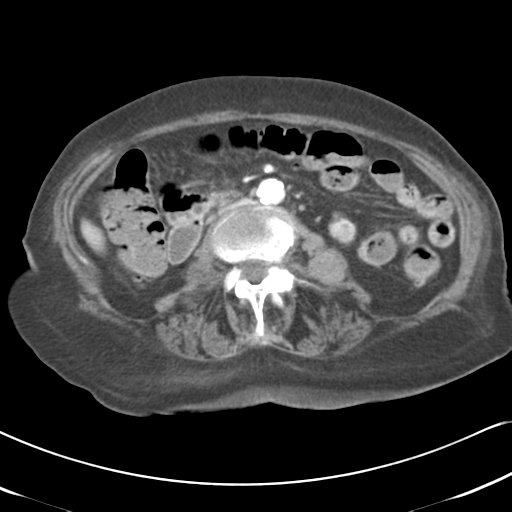 File:Active bleeding from duodenal ulcer with embolization (Radiopaedia 34216-35481 C 30).png