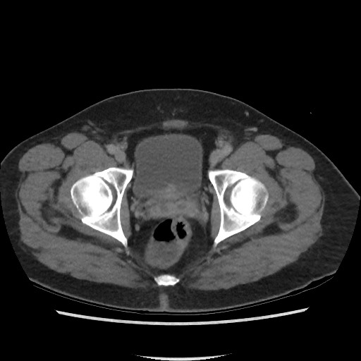File:Active colonic bleed on CT (Radiopaedia 49765-55025 Axial C+ delayed 78).jpg