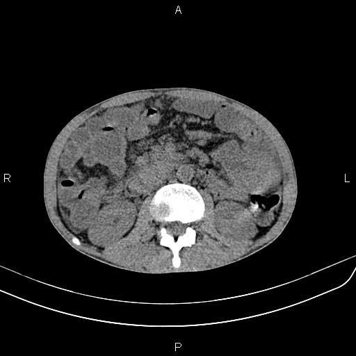 Active crohn disease (Radiopaedia 87133-103397 Axial non-contrast 46).jpg