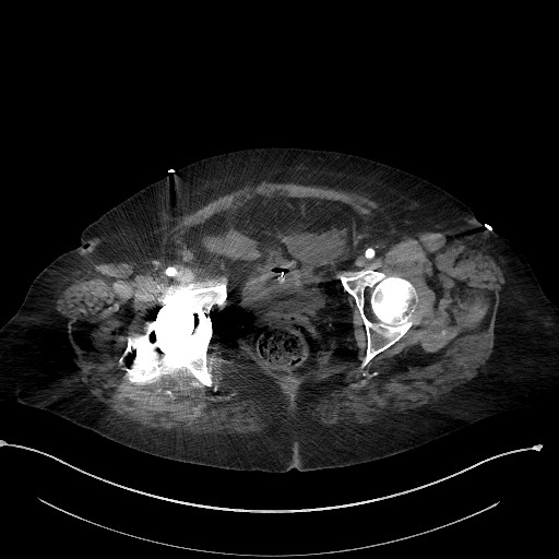Active renal extravasation with large subcapsular and retroperitoneal hemorrhage (Radiopaedia 60975-68796 Axial C+ arterial phase 186).jpg