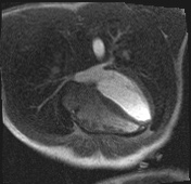 Active right ventricular cardiac sarcoidosis (Radiopaedia 55596-62100 Axial Dynamic perfusion scan MOCO 70).jpg