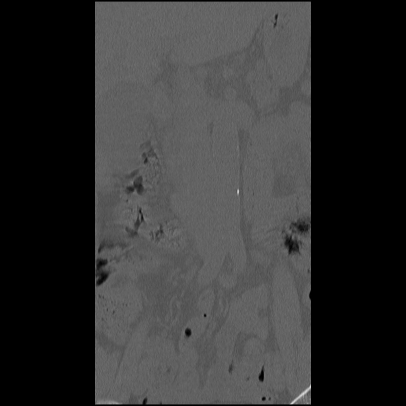 Acute Schmorl's node (Radiopaedia 83276-102365 Coronal bone window 7).jpg