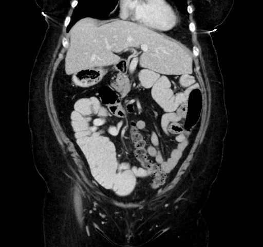 Acute appendicitis, heterotaxy syndrome (Radiopaedia 66884-76202 Coronal C+ portal venous phase 38).jpg