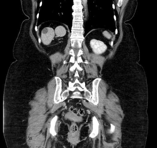 Acute appendicitis, heterotaxy syndrome (Radiopaedia 66884-76202 Coronal C+ portal venous phase 93).jpg