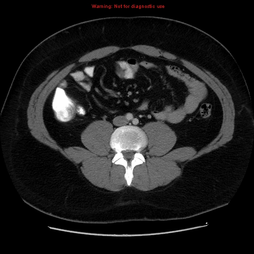 File:Acute appendicitis (Radiopaedia 12326-12607 Axial C+ portal venous phase 8).jpg