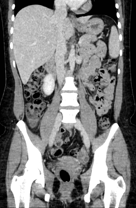 Acute appendicitis (Radiopaedia 22892-22918 Coronal C+ portal venous phase 28).png