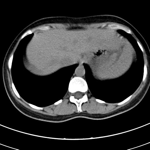 Acute appendicitis (Radiopaedia 30261-30888 Axial non-contrast 2).jpg