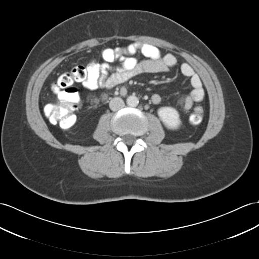 Acute appendicitis (Radiopaedia 30297-30934 Axial C+ portal venous phase 42).jpg