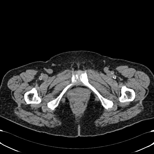 Acute appendicitis (Radiopaedia 58627-65818 Axial non-contrast 92).jpg