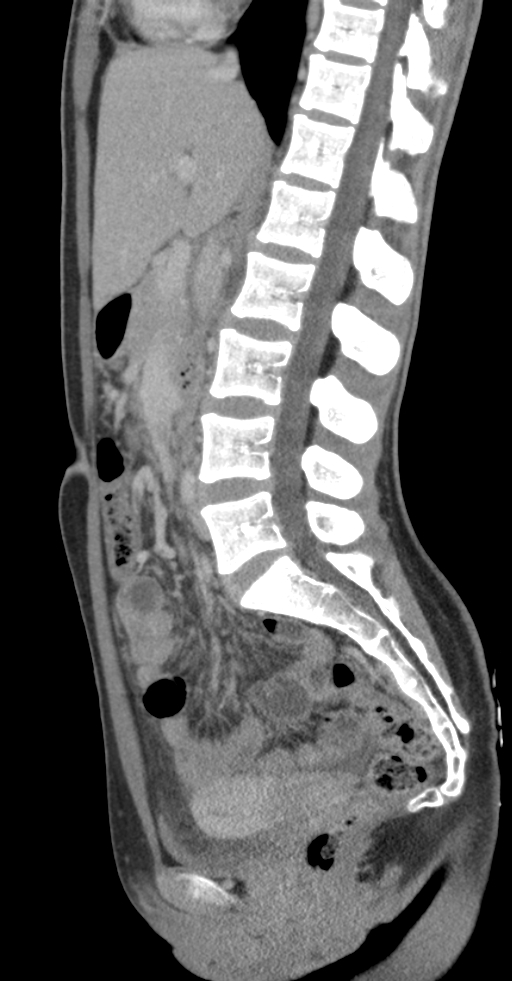 Acute appendicitis (Radiopaedia 62608-70901 Sagittal C+ portal venous phase 20).jpg