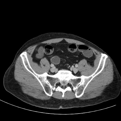 Acute appendicitis (Radiopaedia 66513-75790 Axial C+ portal venous phase 68).jpg