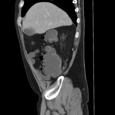 Acute appendicitis (Radiopaedia 66513-75790 Sagittal C+ portal venous phase 27).jpg
