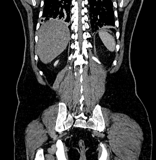 Acute appendicitis (Radiopaedia 79950-93224 Coronal C+ portal venous phase 76).jpg