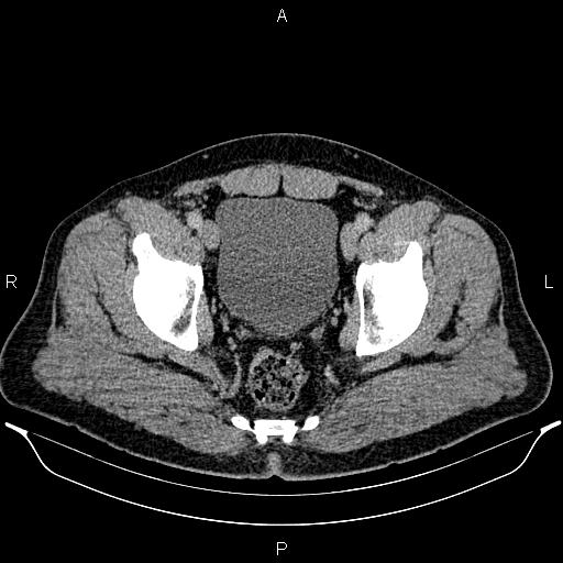 Acute appendicitis (Radiopaedia 84780-100240 Axial C+ portal venous phase 99).jpg
