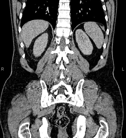 Acute appendicitis (Radiopaedia 84780-100240 Coronal C+ portal venous phase 64).jpg