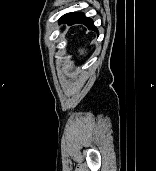Acute appendicitis (Radiopaedia 84780-100240 Sagittal C+ portal venous phase 103).jpg