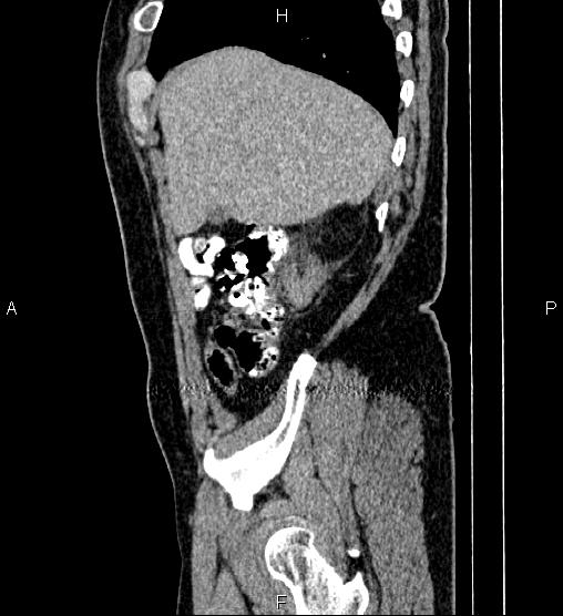 Acute appendicitis (Radiopaedia 84780-100240 Sagittal C+ portal venous phase 15).jpg