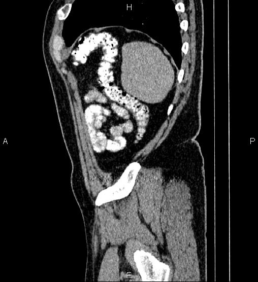 Acute appendicitis (Radiopaedia 84780-100240 Sagittal C+ portal venous phase 94).jpg