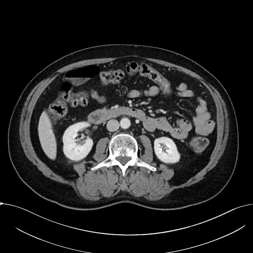 Acute appendicitis - large appendicoliths (Radiopaedia 61805-69820 Axial C+ portal venous phase 60).jpg