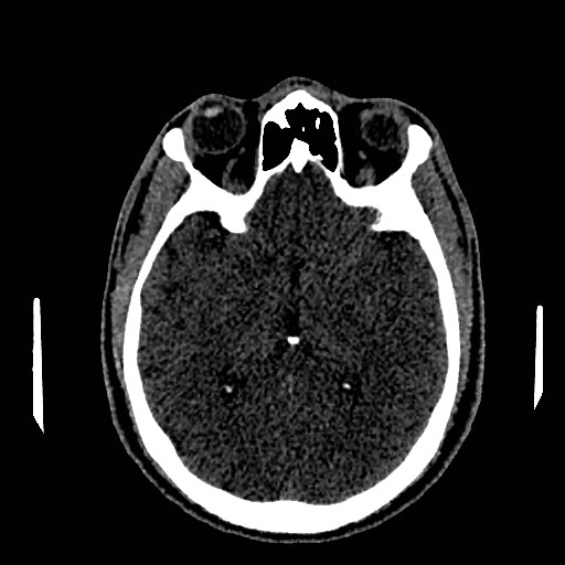 Acute basilar artery occlusion (Radiopaedia 43582-46985 Axial non-contrast 89).jpg