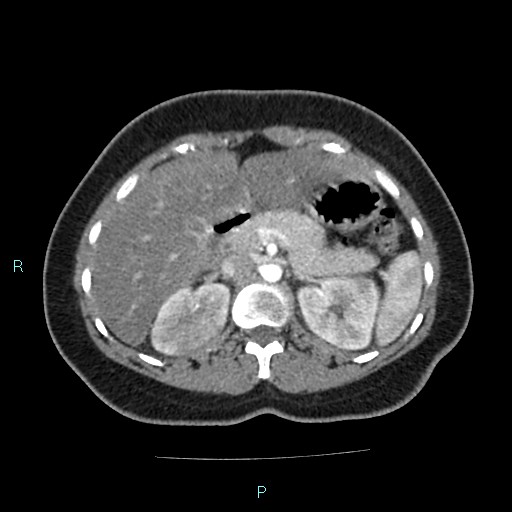 File:Acute bilateral pyelonephritis (Radiopaedia 37146-38881 Axial C+ arterial phase 60).jpg