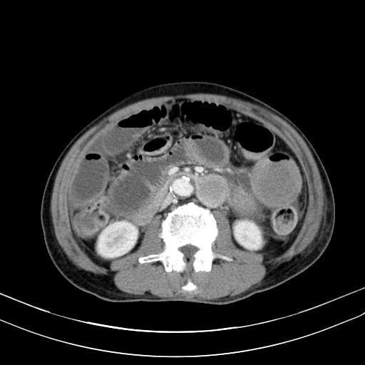 Acute bowel ischemia (Radiopaedia 87695-104114 Axial C+ portal venous phase 41).jpg