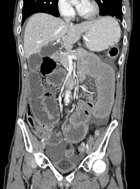Acute bowel ischemia (Radiopaedia 87695-104114 Coronal C+ portal venous phase 179).jpg