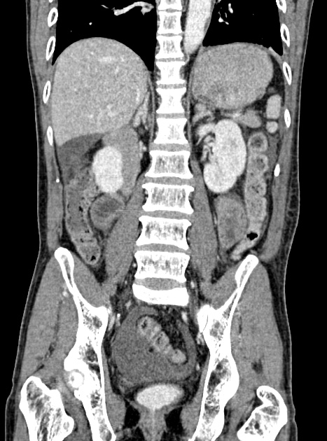 Acute bowel ischemia (Radiopaedia 87695-104114 Coronal C+ portal venous phase 248).jpg
