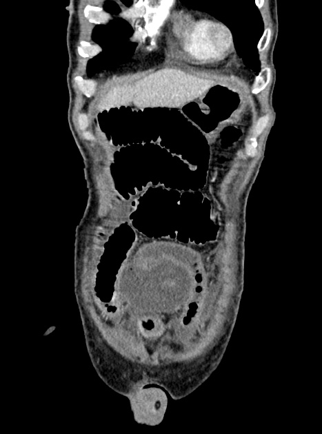 Acute bowel ischemia (Radiopaedia 87695-104114 Coronal C+ portal venous phase 98).jpg