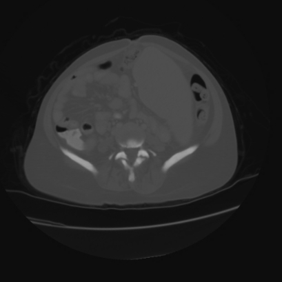 File:Acute calculous cholecystitis in patient with osteopetrosis (Radiopaedia 77871-90159 Axial bone window 32).jpg