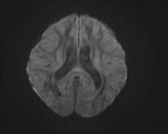 File:Acute cerebellar ataxia (Radiopaedia 61487-69446 Axial DWI 13).jpg