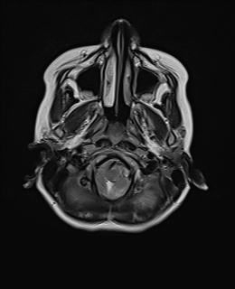File:Acute cerebellar ataxia (Radiopaedia 61487-69446 Axial T2 2).jpg