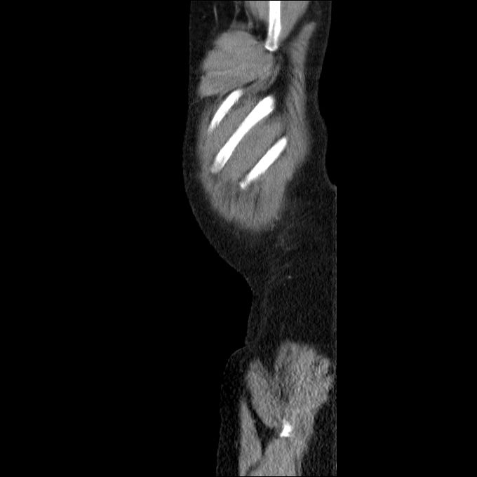Acute cholecystitis and incidental left sided IVC (Radiopaedia 49352-54459 Sagittal C+ portal venous phase 7).jpg