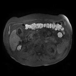 File:Acute cholecystitis complicated by pylephlebitis (Radiopaedia 65782-74915 Axial T1 fat sat 64).jpg