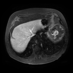 Acute cholecystitis complicated by pylephlebitis (Radiopaedia 65782-74915 Axial arterioportal phase T1 C+ fat sat 13).jpg