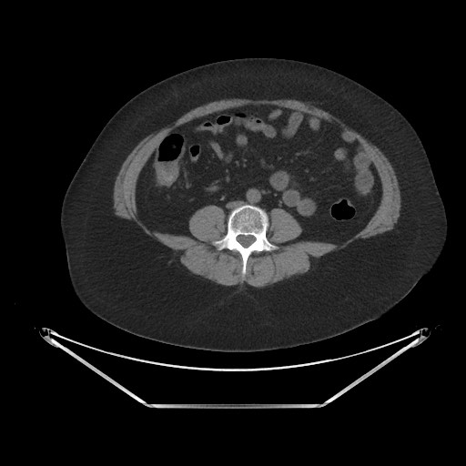 Acute cholecystitis with tensile fundus sign (Radiopaedia 71394-81723 Axial non-contrast 63).jpg