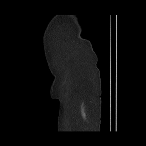 File:Acute cholecystitis with tensile fundus sign (Radiopaedia 71394-81723 Sagittal non-contrast 22).jpg