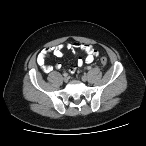 Acute diverticulitis with localized perforation (Radiopaedia 41296-44113 Axial C+ portal venous phase 67).jpg
