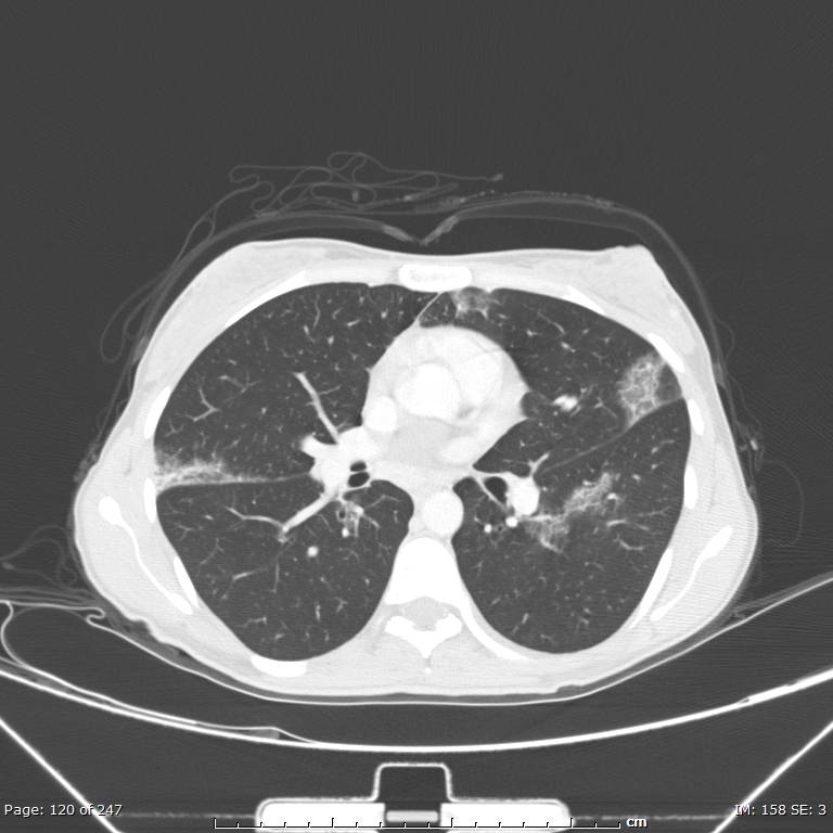 Acute eosinophilic pneumonia (Radiopaedia 48211-53073 Axial lung window 43).jpg