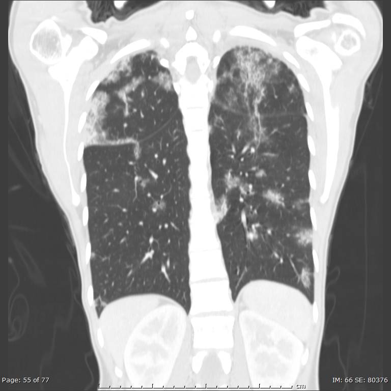 Acute eosinophilic pneumonia (Radiopaedia 48211-53073 Coronal lung window 37).jpg