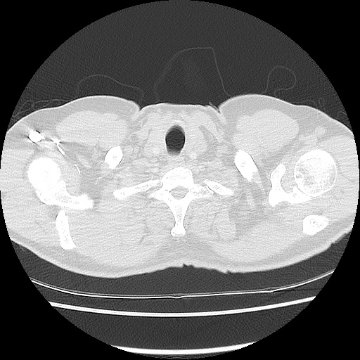Acute epicardial fat necrosis (Radiopaedia 42327-45440 Axial lung window 6).jpg