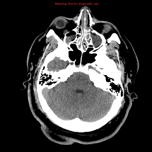 Acute hemorrhagic leukoencephalitis (Radiopaedia 14076-13920 Axial non-contrast 11).jpg