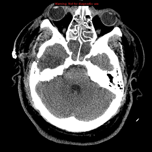 Acute hemorrhagic leukoencephalitis (Radiopaedia 14076-43697 Axial non-contrast 12).jpg