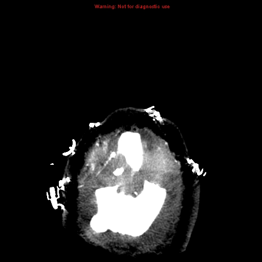 File:Acute hemorrhagic leukoencephalitis (Radiopaedia 14076-43697 Axial non-contrast 49).jpg
