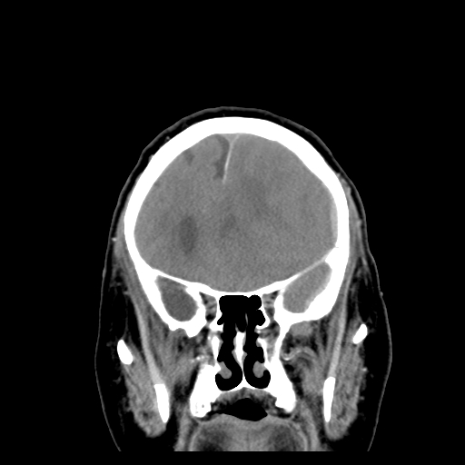 File:Acute hemorrhagic stroke (Radiopaedia 17507-17223 Coronal non-contrast 15).jpg