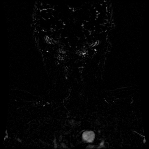 Acute internal carotid artery dissection (Radiopaedia 53541-59632 Coronal MRA 12).jpg