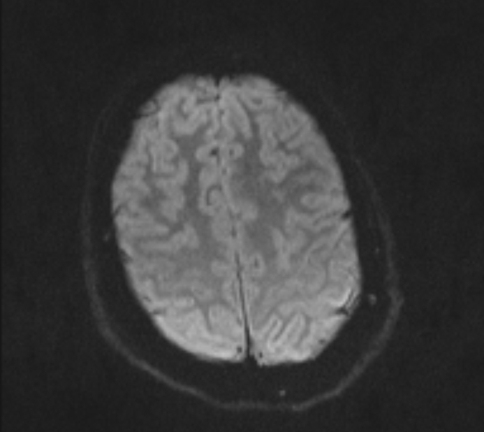 Acute ischemic stroke - posterior circulation territory (Radiopaedia 77670-89880 Axial DWI 42).jpg