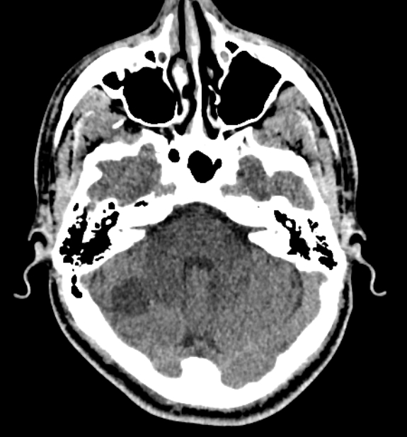 Acute ischemic stroke - posterior circulation territory (Radiopaedia 77670-89881 non-contrast 21).jpg
