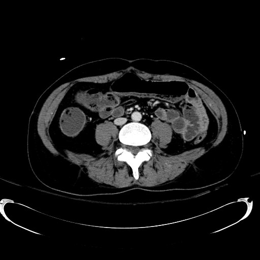 Acute myocardial infarction in CT (Radiopaedia 39947-42415 Axial C+ portal venous phase 77).jpg