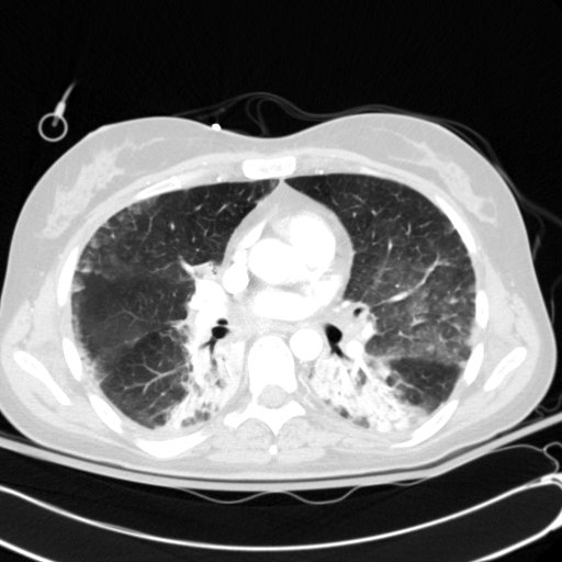 Acute myocardial infarction in CT (Radiopaedia 39947-42415 Axial lung window 64).jpg